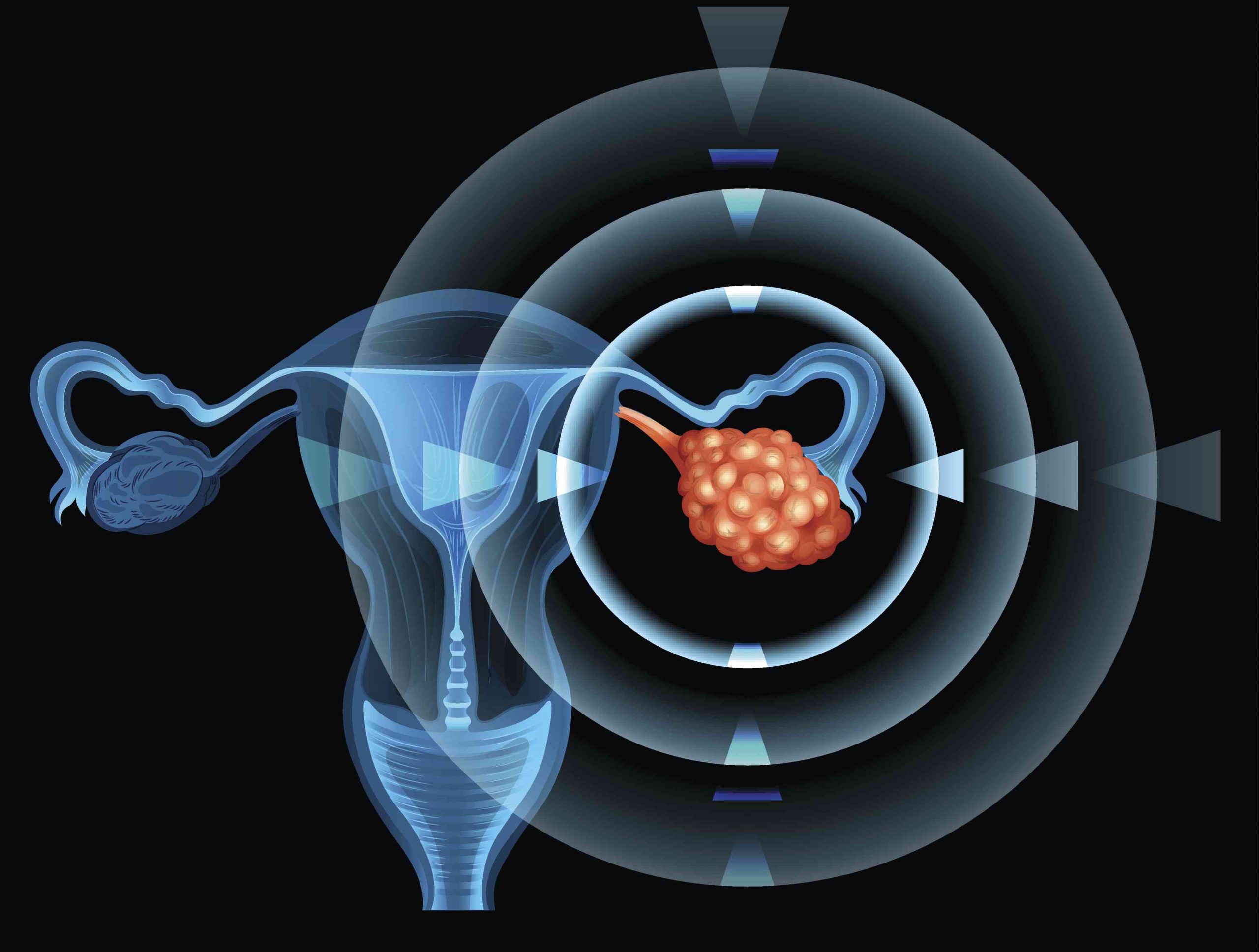 mutated-gene-causes-ovarian-cancer